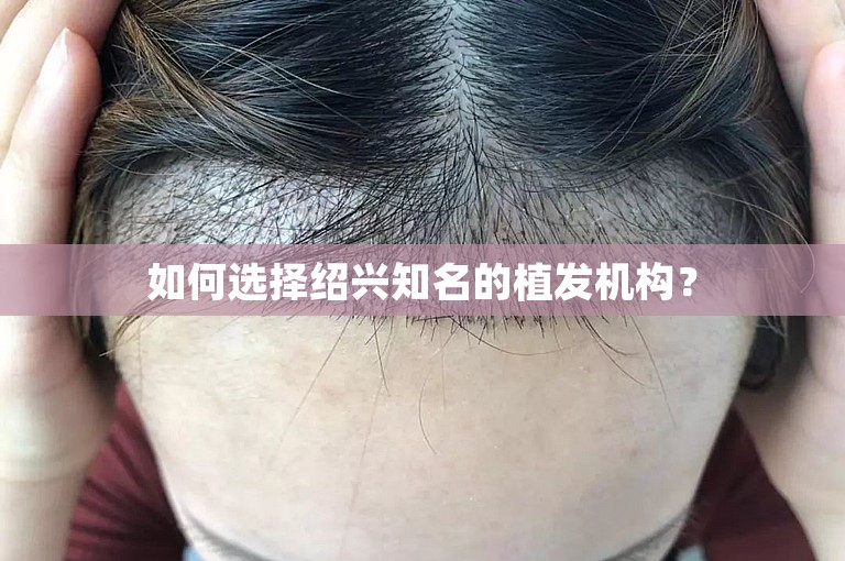 如何选择绍兴知名的植发机构？