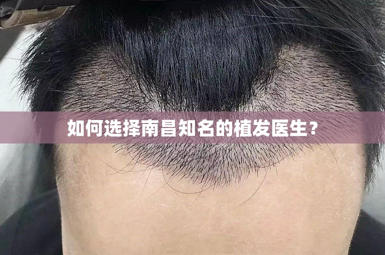 如何选择南昌知名的植发医生？