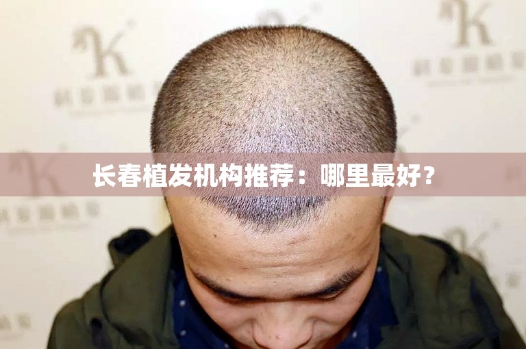 长春植发机构推荐：哪里最好？