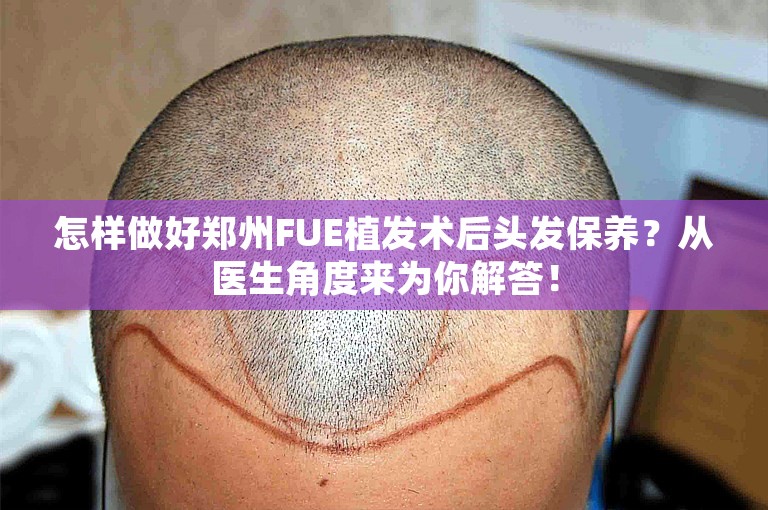 怎样做好郑州FUE植发术后头发保养？从医生角度来为你解答！