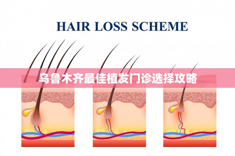 乌鲁木齐最佳植发门诊选择攻略