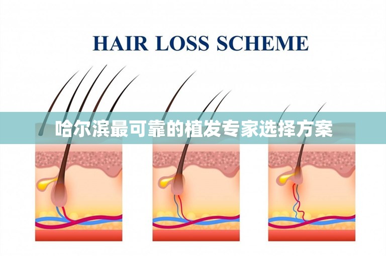 哈尔滨最可靠的植发专家选择方案