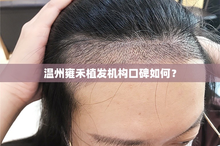 温州雍禾植发机构口碑如何？