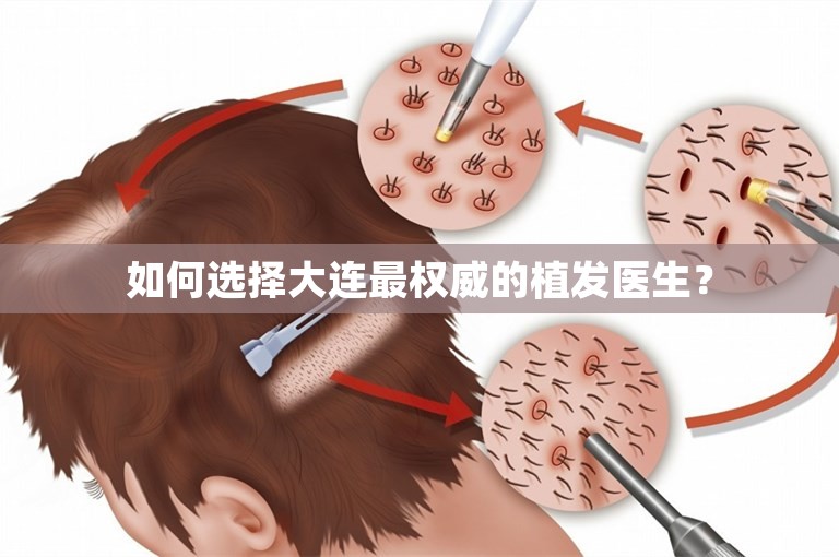 如何选择大连最权威的植发医生？