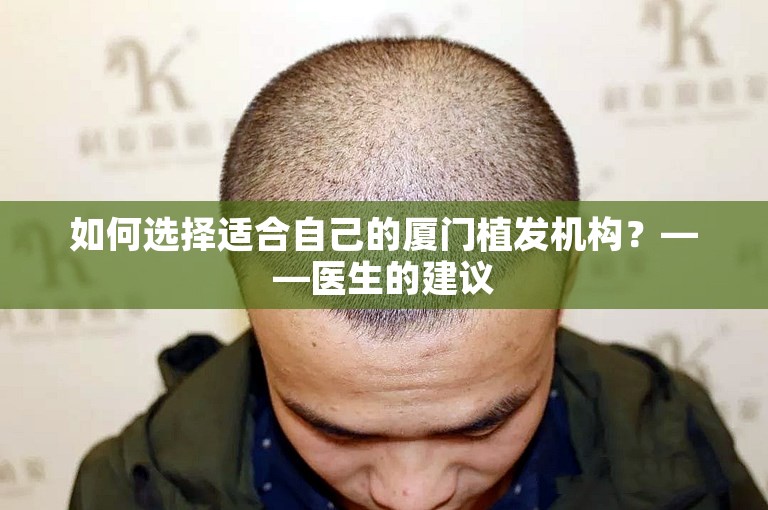 如何选择适合自己的厦门植发机构？——医生的建议