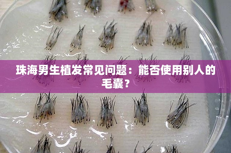 珠海男生植发常见问题：能否使用别人的毛囊？