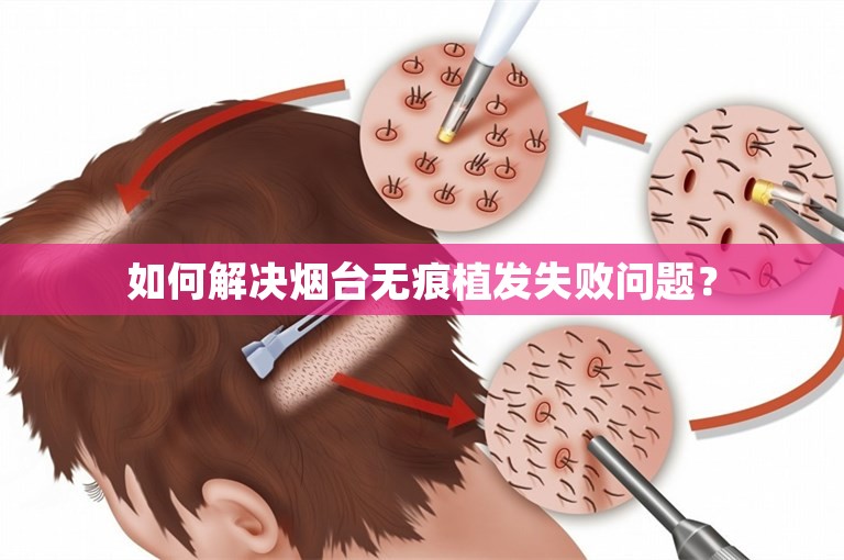 如何解决烟台无痕植发失败问题？