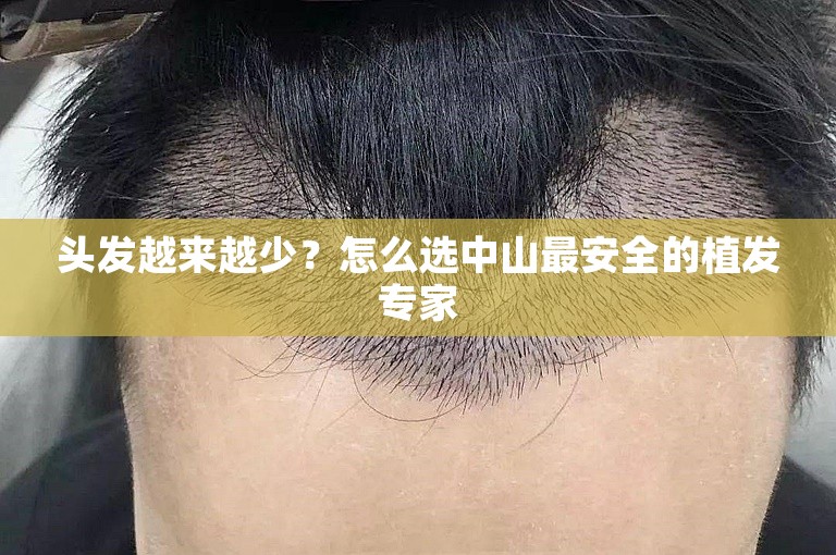 头发越来越少？怎么选中山最安全的植发专家