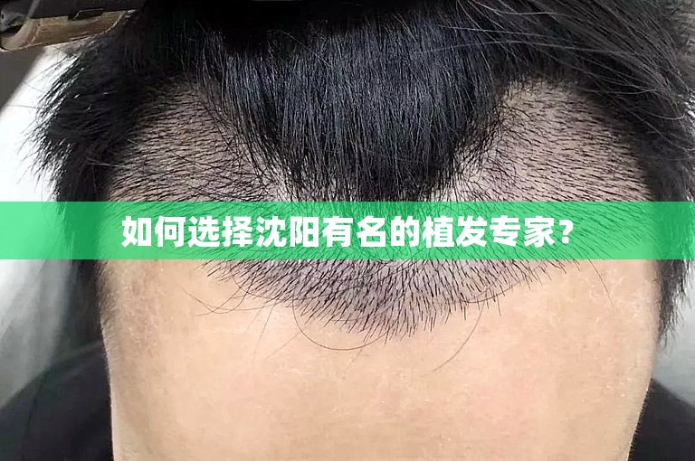 如何选择沈阳有名的植发专家？