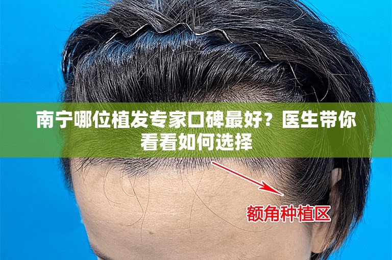 南宁哪位植发专家口碑最好？医生带你看看如何选择