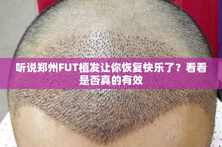 听说郑州FUT植发让你恢复快乐了？看看是否真的有效