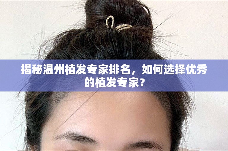 揭秘温州植发专家排名，如何选择优秀的植发专家？