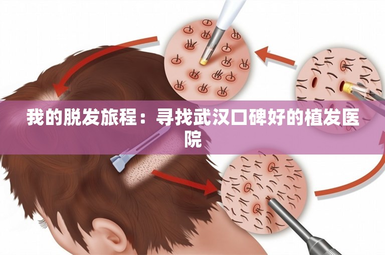 我的脱发旅程：寻找武汉口碑好的植发医院