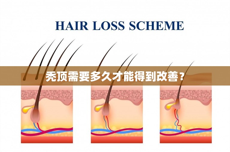 秃顶需要多久才能得到改善？