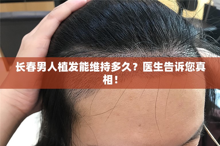 长春男人植发能维持多久？医生告诉您真相！