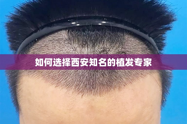 如何选择西安知名的植发专家