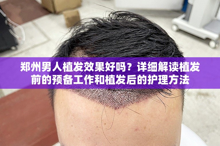 郑州男人植发效果好吗？详细解读植发前的预备工作和植发后的护理方法