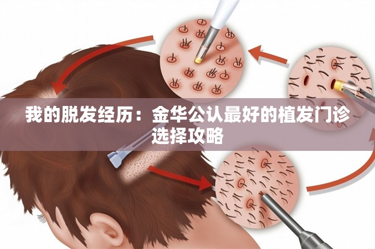 我的脱发经历：金华公认最好的植发门诊选择攻略