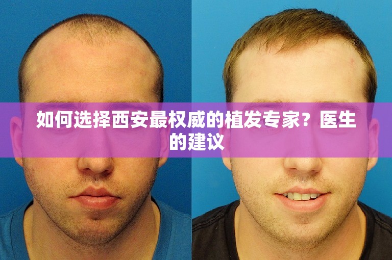 如何选择西安最权威的植发专家？医生的建议