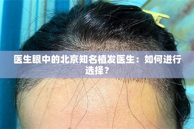 医生眼中的北京知名植发医生：如何进行选择？