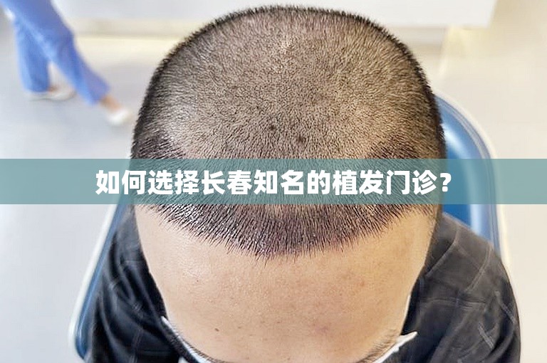 如何选择长春知名的植发门诊？