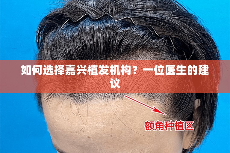 如何选择嘉兴植发机构？一位医生的建议