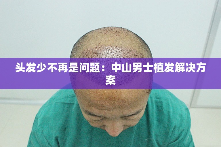 头发少不再是问题：中山男士植发解决方案