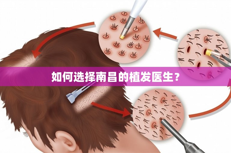 如何选择南昌的植发医生？