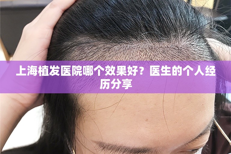 上海植发医院哪个效果好？医生的个人经历分享