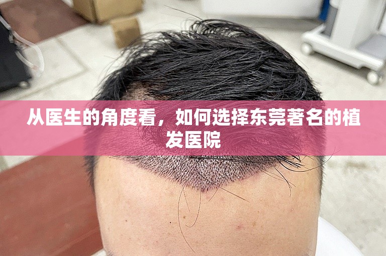 从医生的角度看，如何选择东莞著名的植发医院