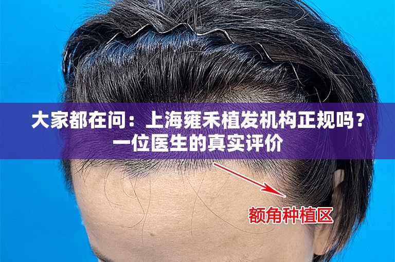 大家都在问：上海雍禾植发机构正规吗？一位医生的真实评价