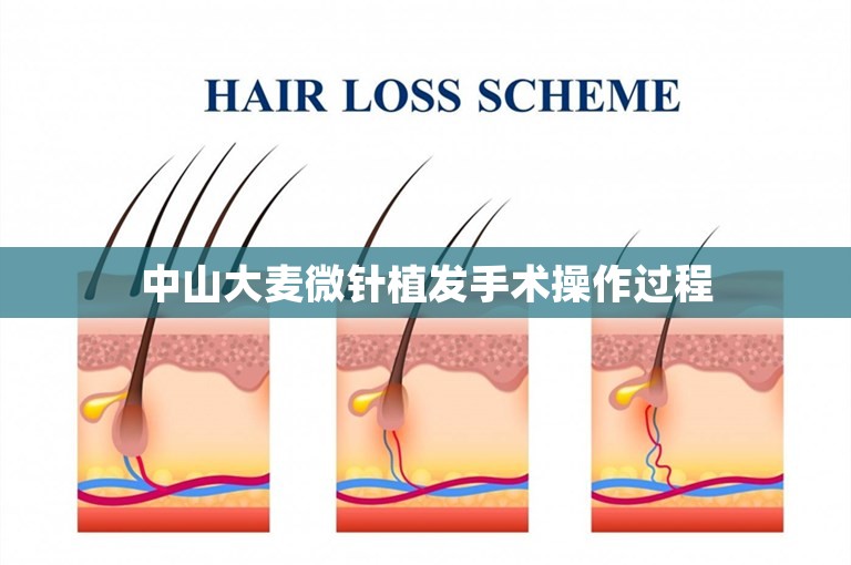 中山大麦微针植发手术操作过程