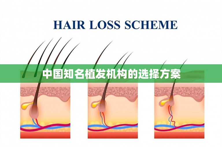 中国知名植发机构的选择方案