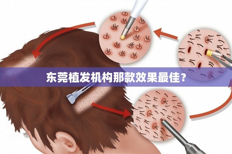 东莞植发机构那款效果最佳？