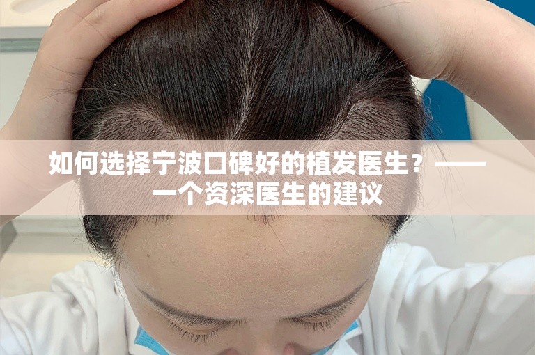 如何选择宁波口碑好的植发医生？——一个资深医生的建议