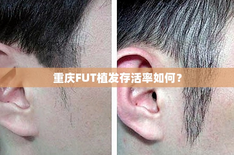 重庆FUT植发存活率如何？