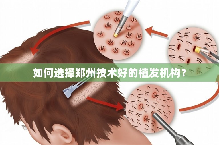 如何选择郑州技术好的植发机构？