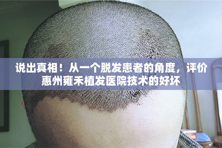 说出真相！从一个脱发患者的角度，评价惠州雍禾植发医院技术的好坏