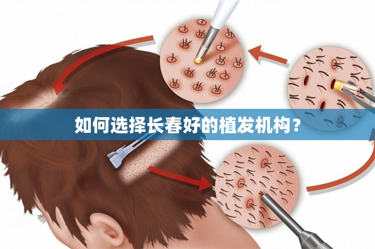 如何选择长春好的植发机构？