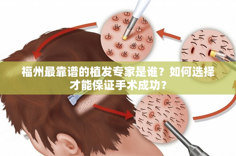 福州最靠谱的植发专家是谁？如何选择才能保证手术成功？