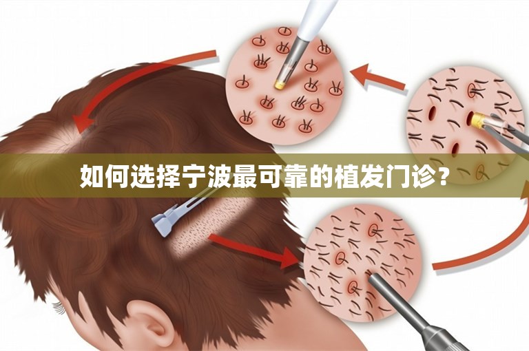 如何选择宁波最可靠的植发门诊？