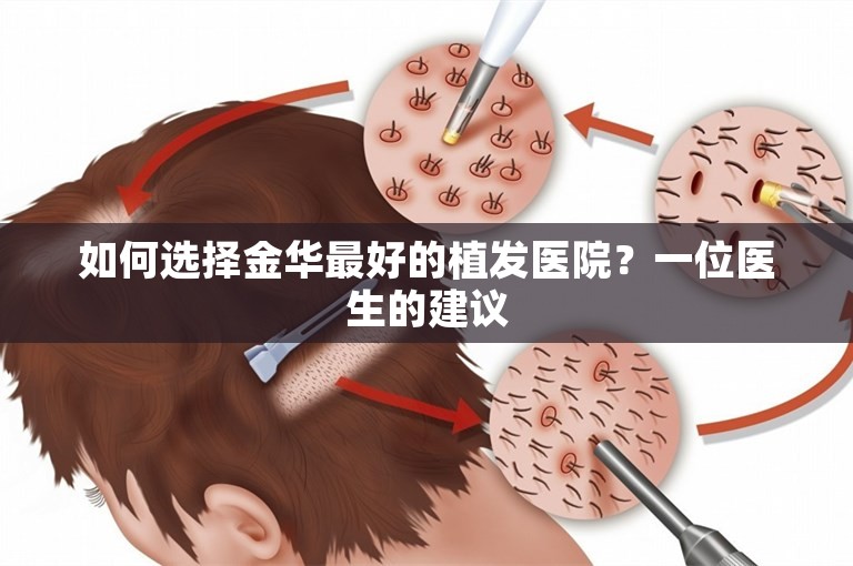 如何选择金华最好的植发医院？一位医生的建议