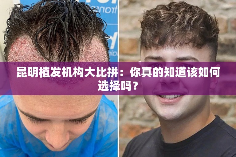 昆明植发机构大比拼：你真的知道该如何选择吗？