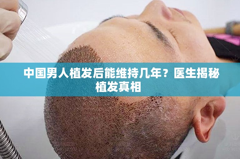  中国男人植发后能维持几年？医生揭秘植发真相 