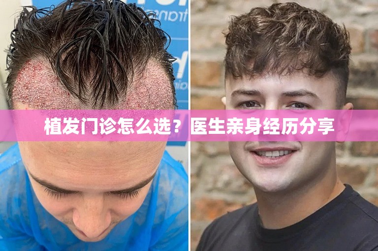 植发门诊怎么选？医生亲身经历分享