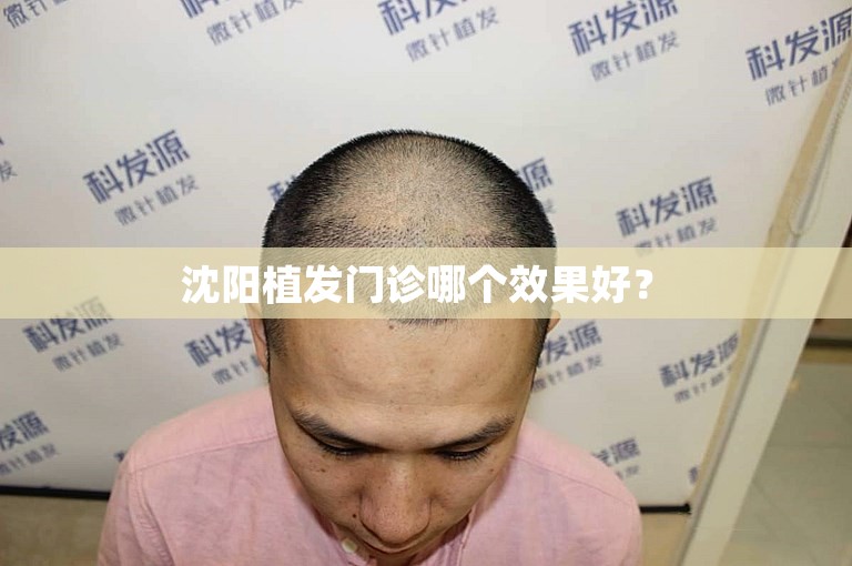  沈阳植发门诊哪个效果好？ 