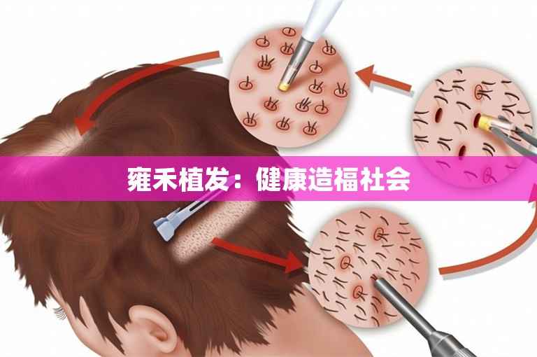 雍禾植发：健康造福社会