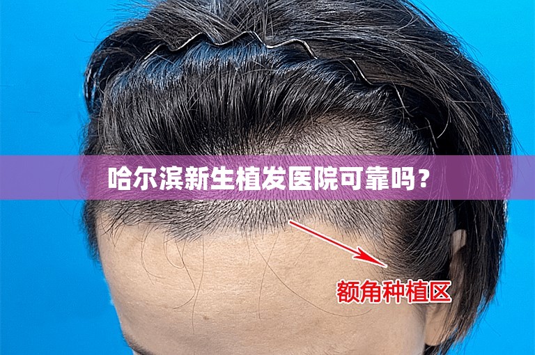 哈尔滨新生植发医院可靠吗？