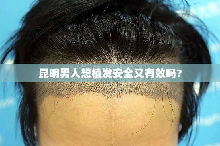 昆明男人想植发安全又有效吗？