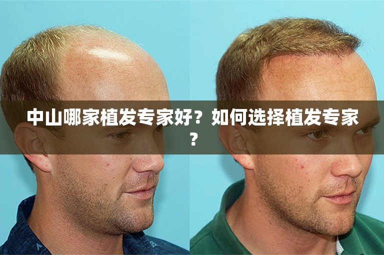 中山哪家植发专家好？如何选择植发专家？